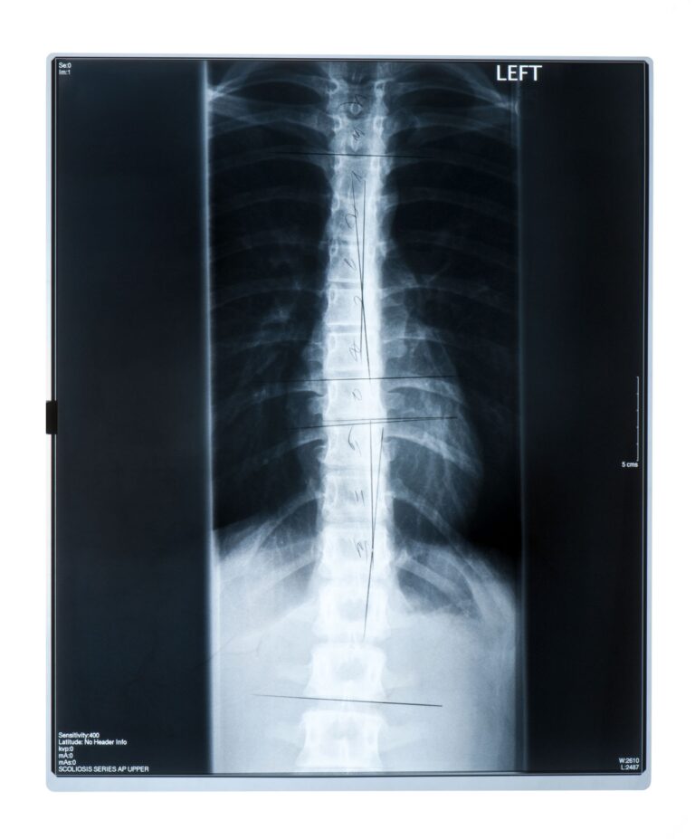 Scheuermann - Krankheit